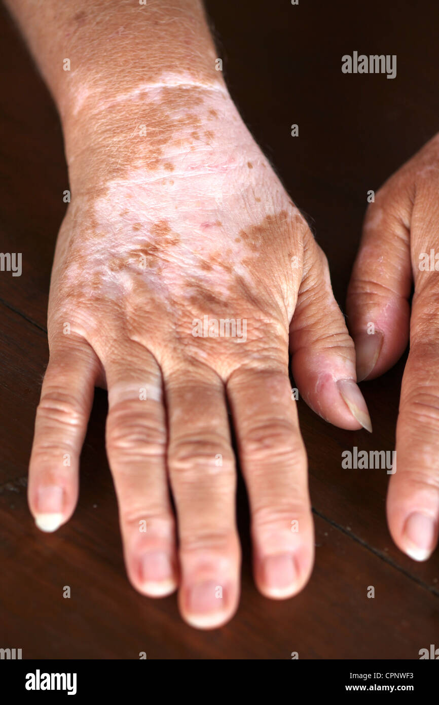 Piebald human hires stock photography and images Alamy