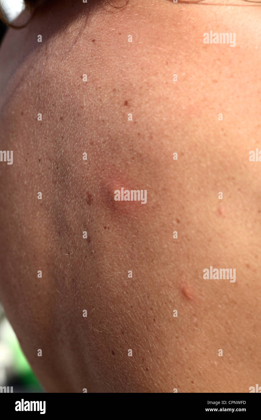 Bite backs hi-res stock photography and images - Alamy