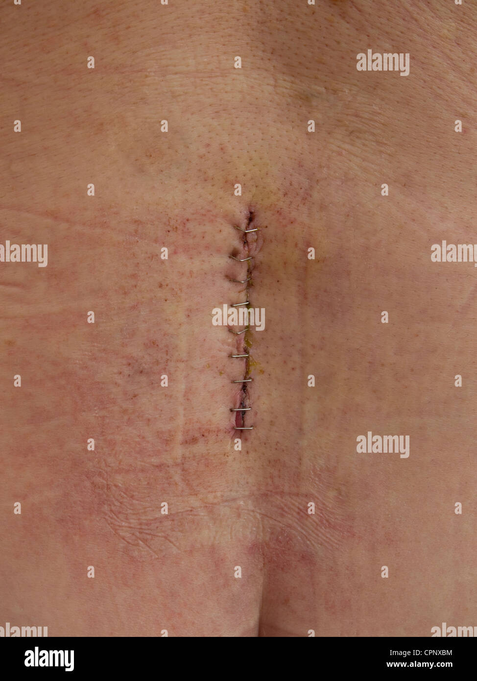 The wound site of a lumbar discectomy to remove herniated disc material in a male, held together by metal clips Stock Photo