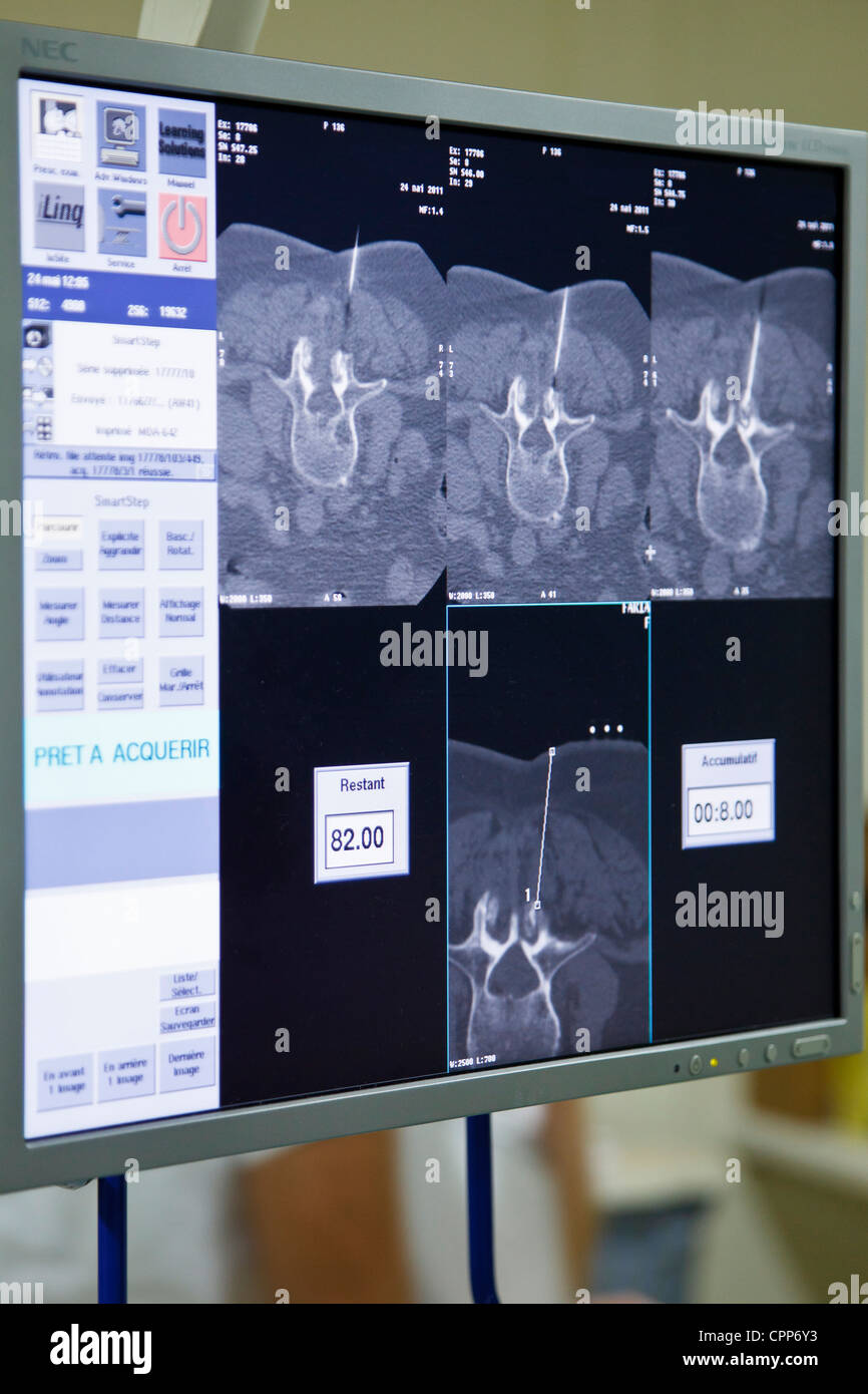 LUMBAR VERTEBRA, INFILTRATION Stock Photo - Alamy