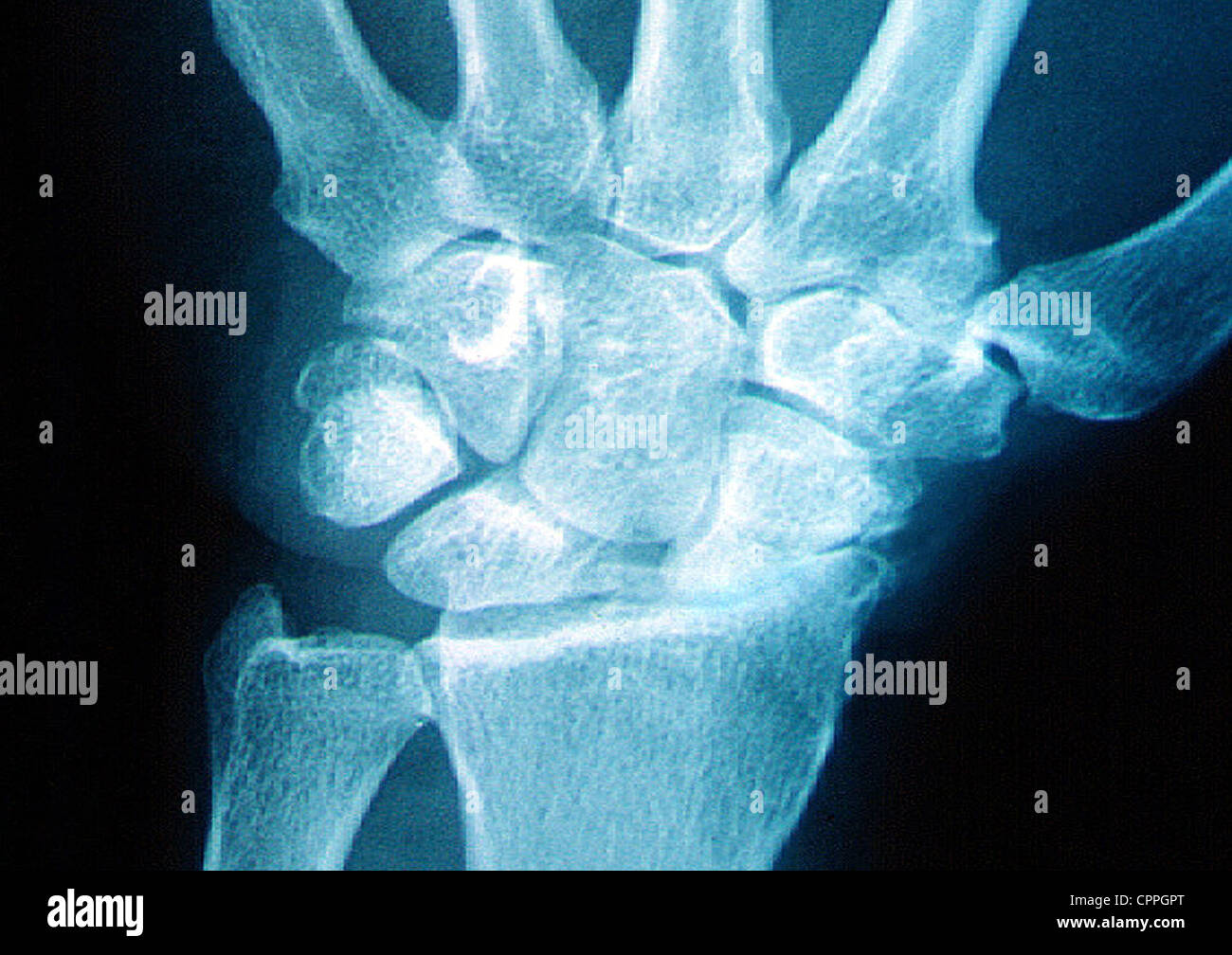 Osteoarthritis hands hires stock photography and images Alamy