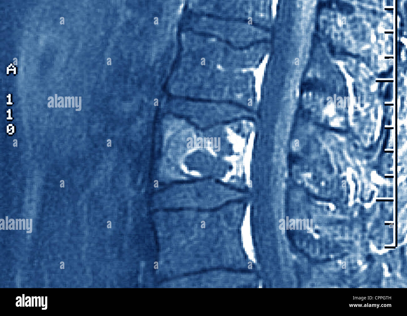 Multiple Myeloma High Resolution Stock Photography and Images - Alamy