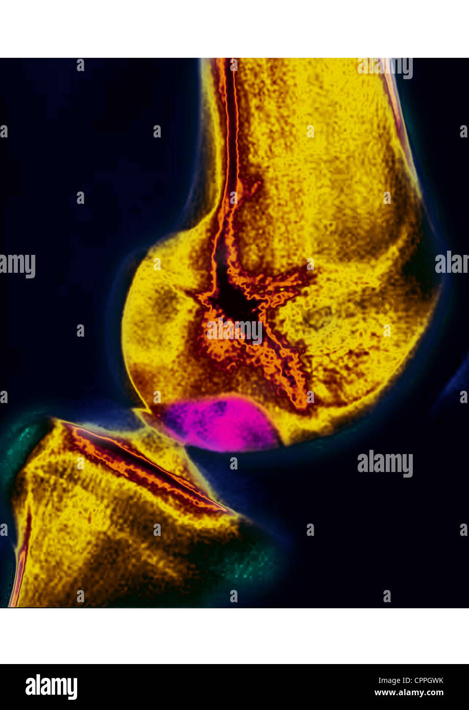 Exostis Exostosis hi-res stock photography and images - Alamy