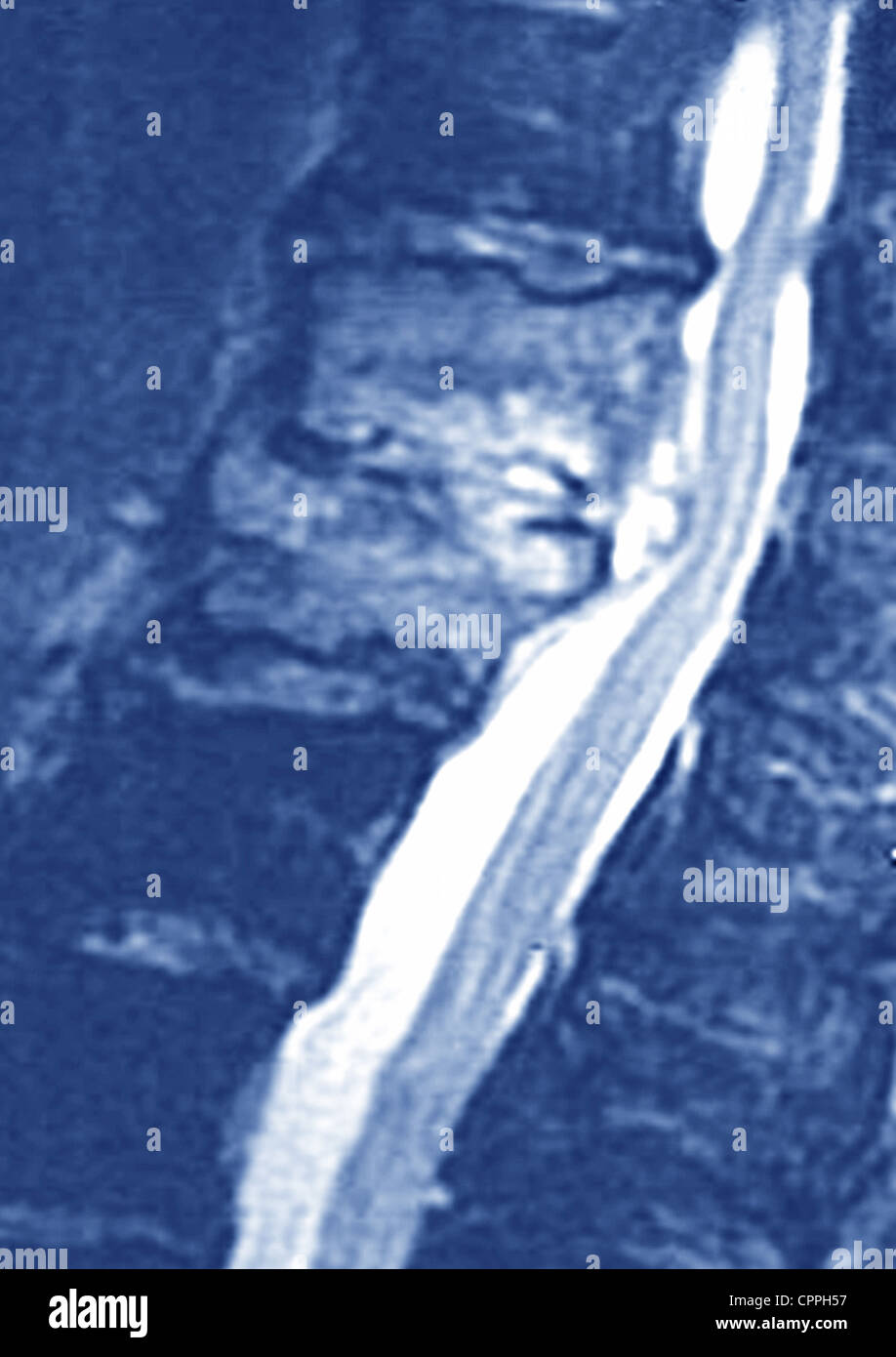 Mri of thoracic spine hi-res stock photography and images - Alamy