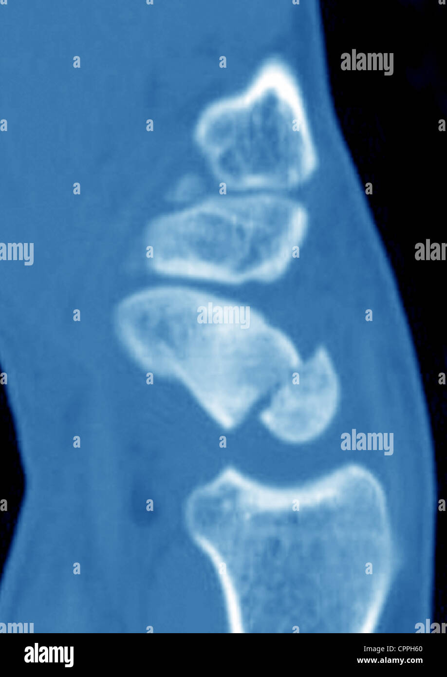 FRACTURED WRIST, XRAY Stock Photo Alamy