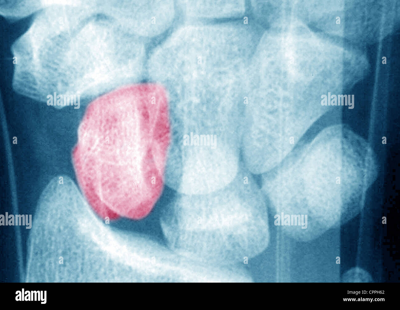 FRACTURED WRIST, XRAY Stock Photo Alamy