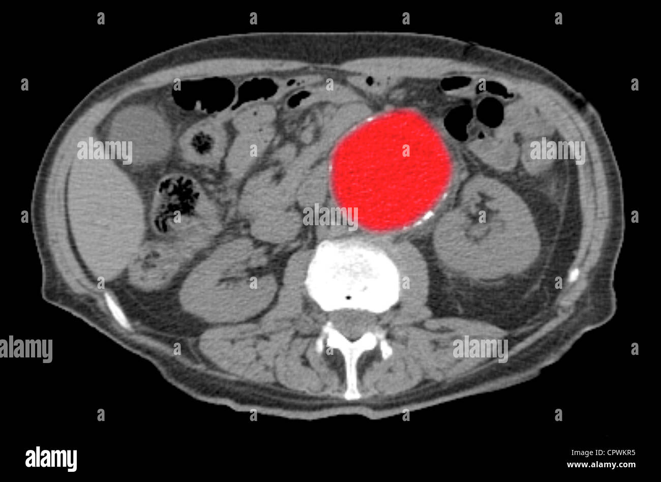 CT scan showing aortic aneurysm Stock Photo
