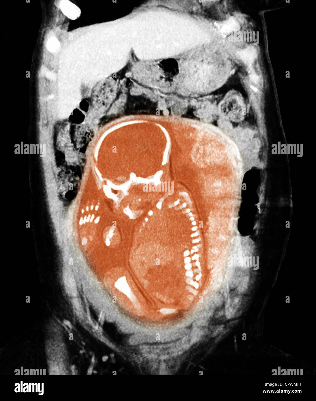 CT scan showing a nearly full term infant in breech position Stock Photo
