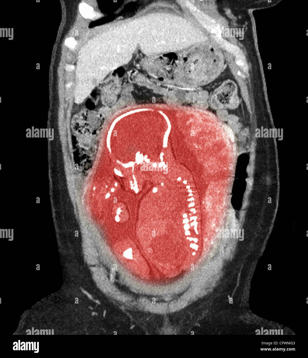 CT scan showing a nearly full term infant in breech position Stock Photo