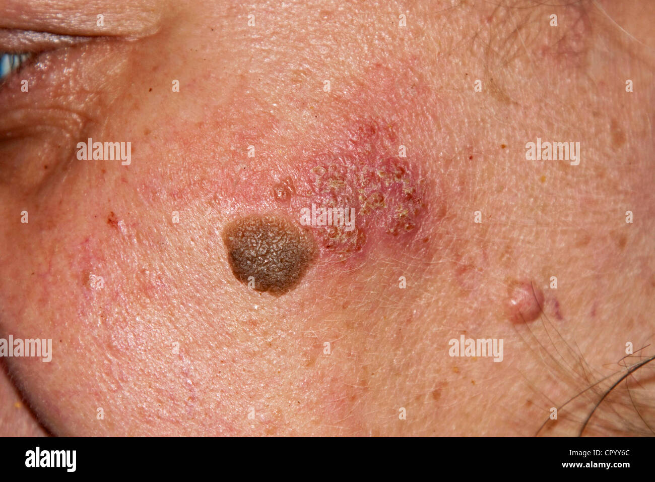 Inflamed skin rash due to a chromium-nickel allergy and seborrheic keratosis, seborrheic verruca or senile wart on the face of a Stock Photo