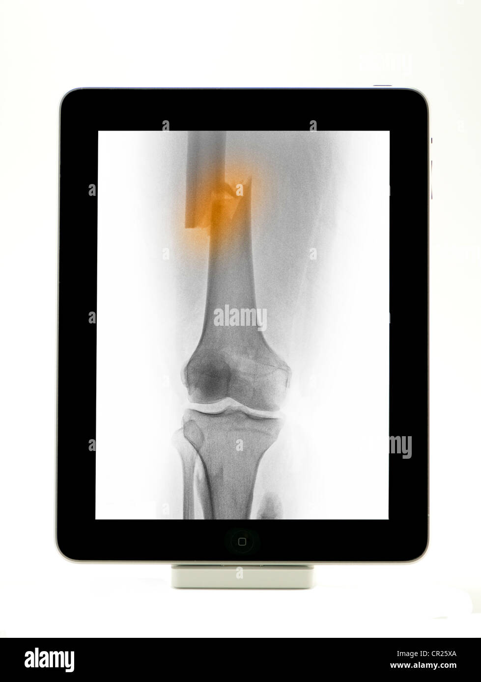 iPad showing an x-ray of a femur fracture Stock Photo