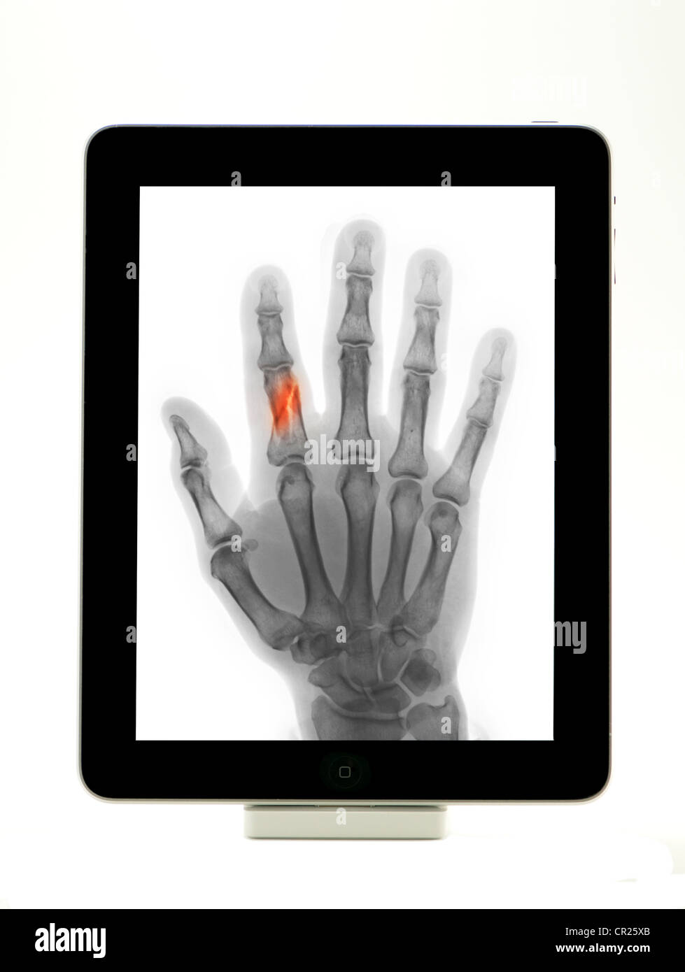 iPad showing an x-ray of a broken finger Stock Photo
