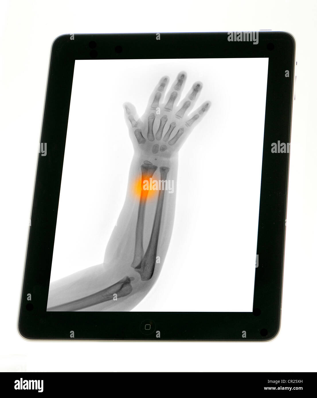 iPad showing an x-ray of a young child's forearm which has been fractured Stock Photo