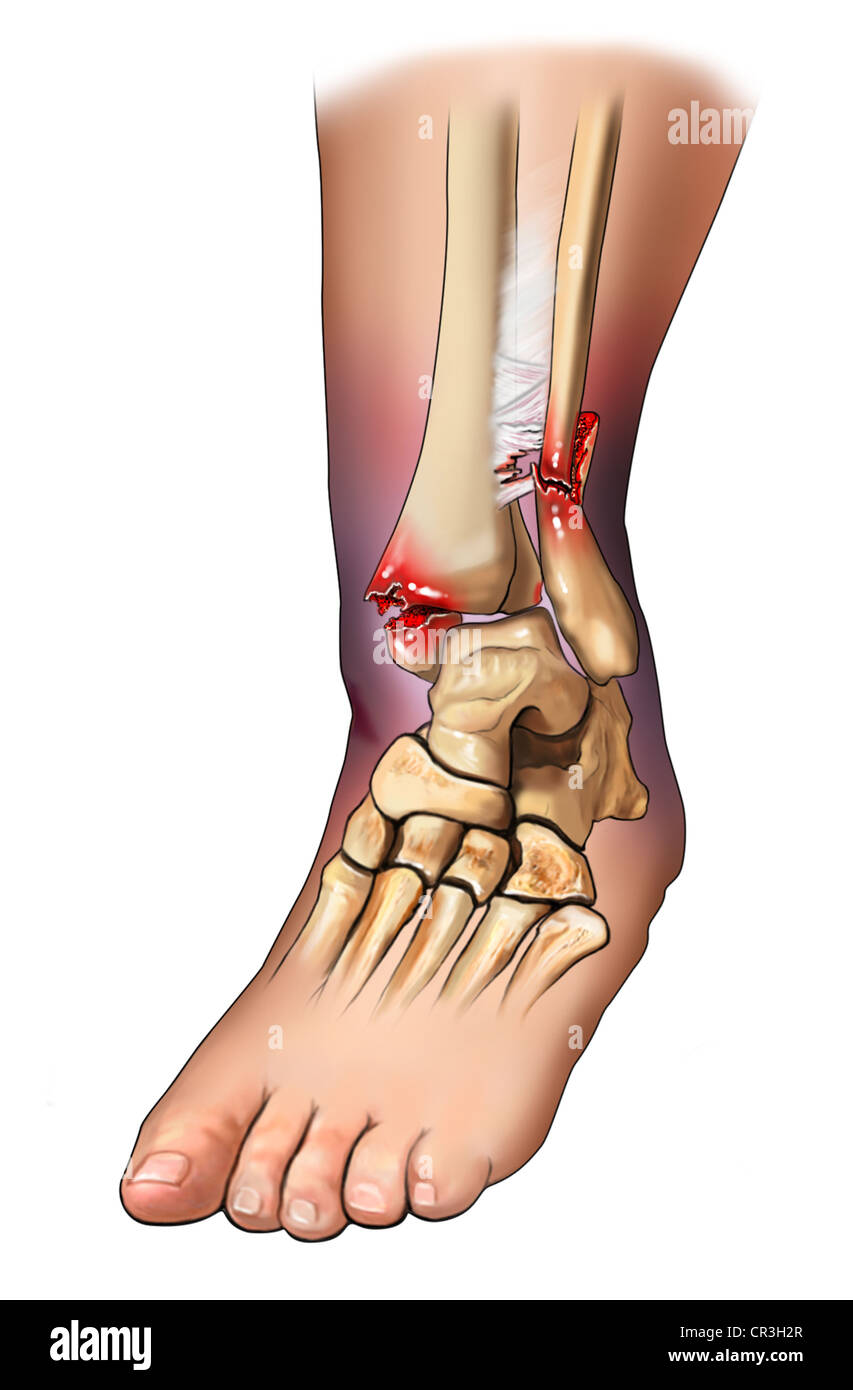 bimalleolar ankle fracture surgery