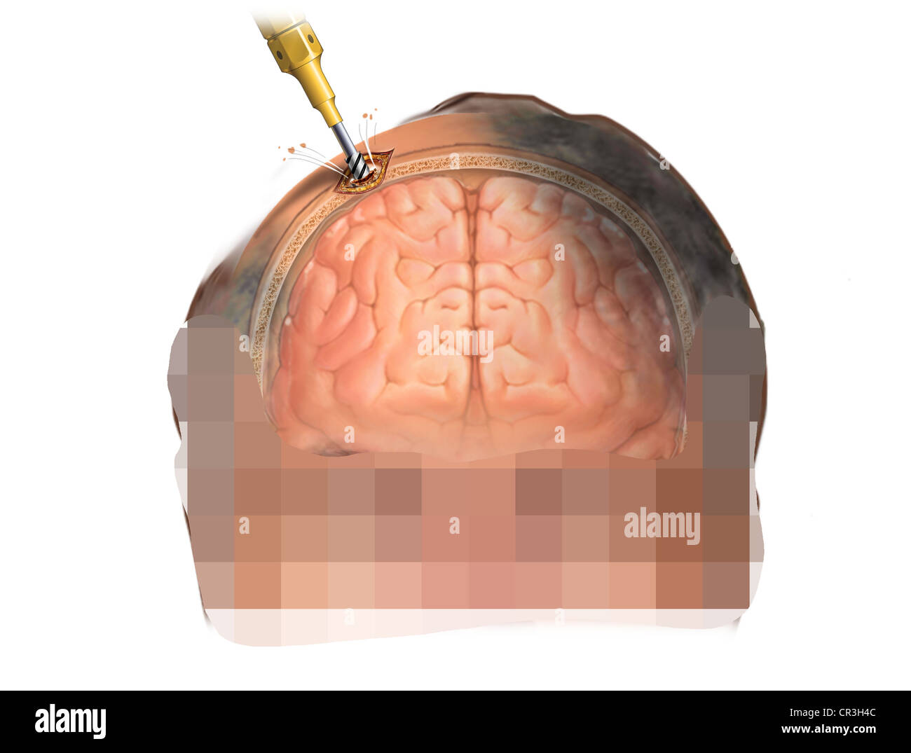 Cranial brain trauma hires stock photography and images Alamy
