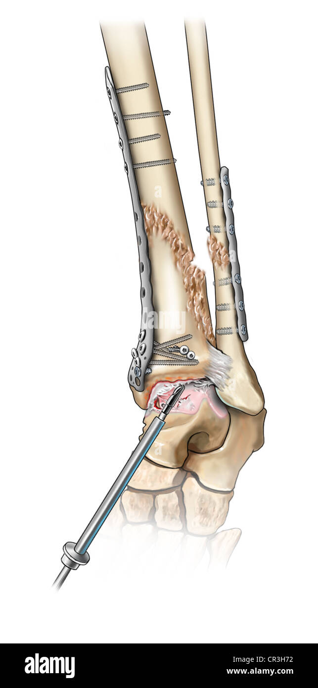 Arthroscopic Surgery Debridement of Cartilage Tear and Soft Tissue