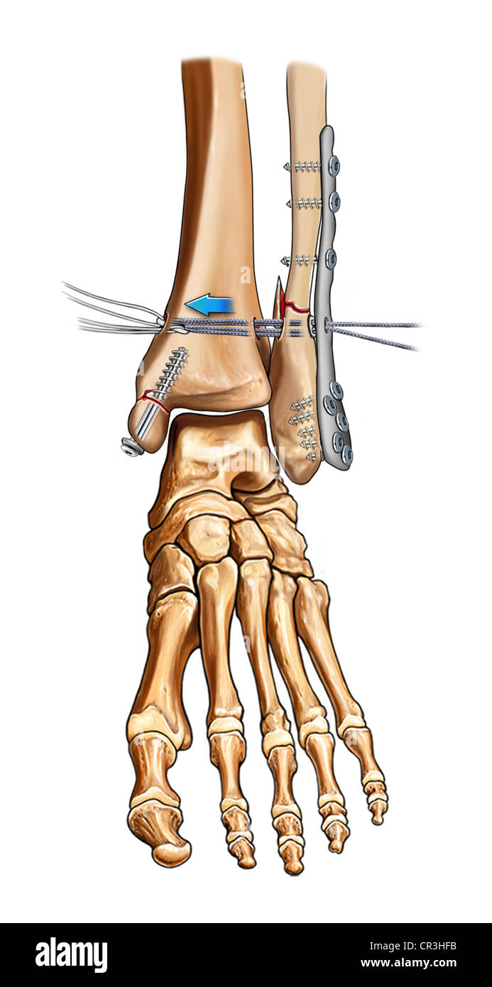 Syndesmosis Fixation with Tightrope Device Stock Photo Alamy