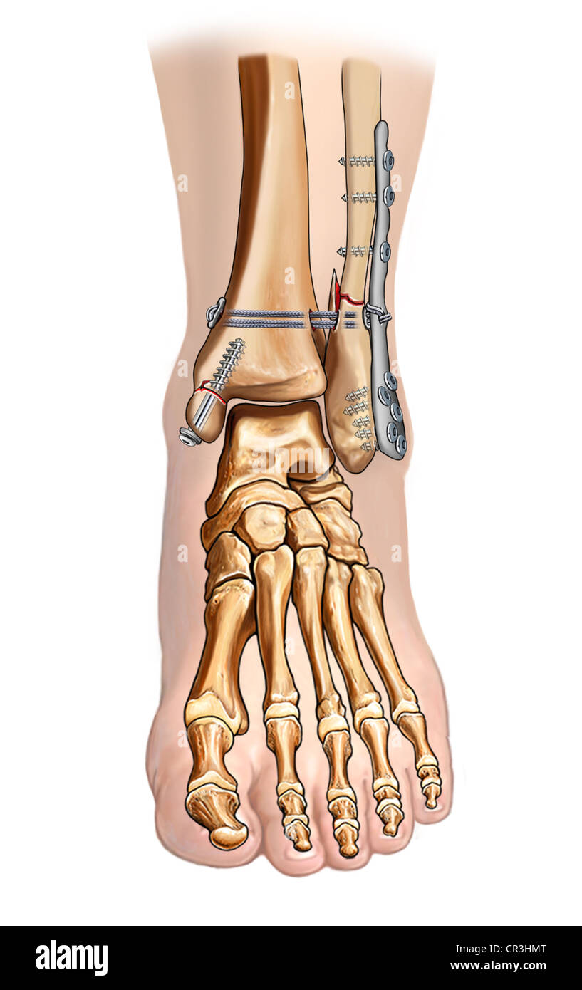 Bimalleolar Fracture Fixation and Syndesmosis Fixation Stock Photo Alamy