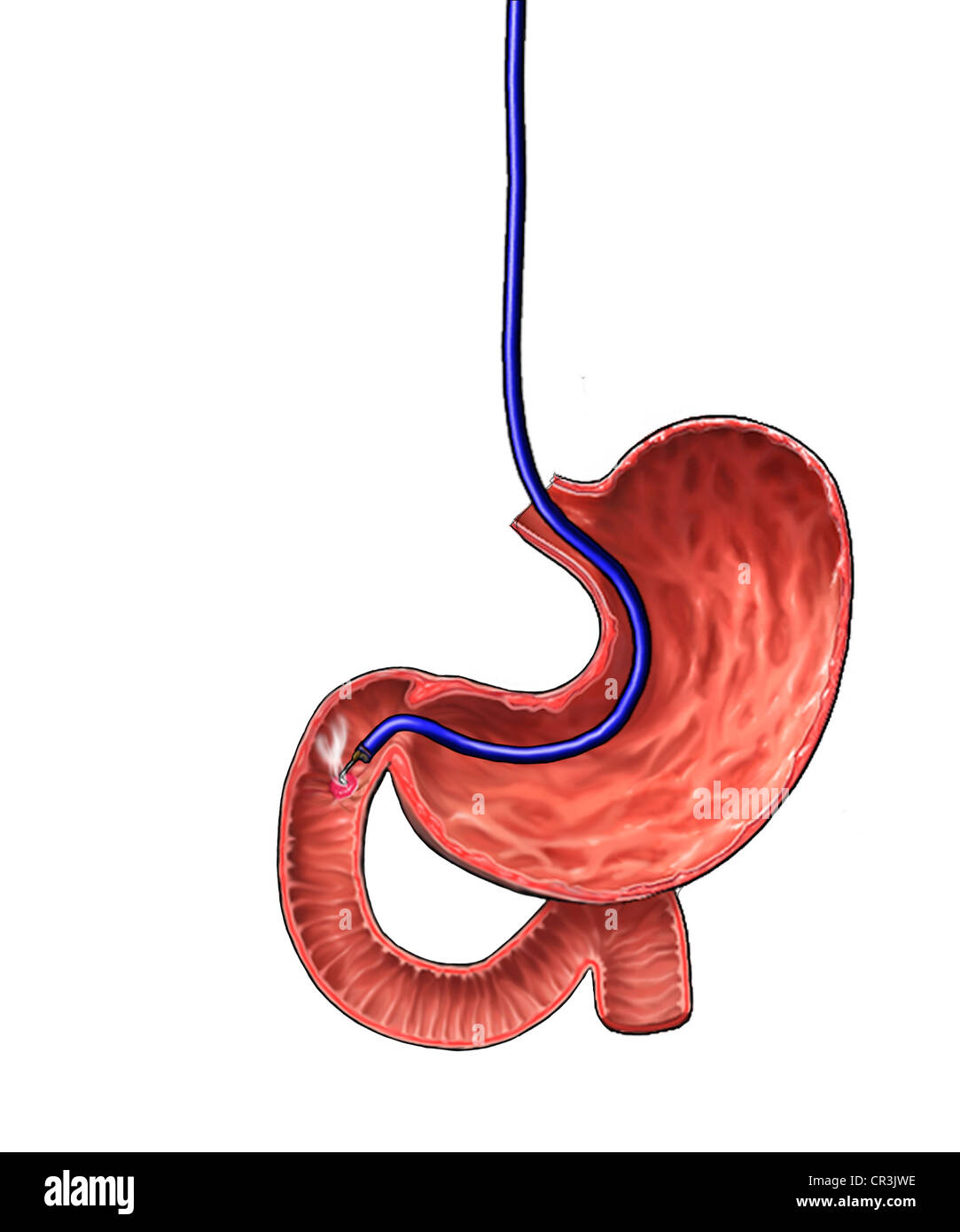 Esophagogastroduodenoscopy hires stock photography and images Alamy