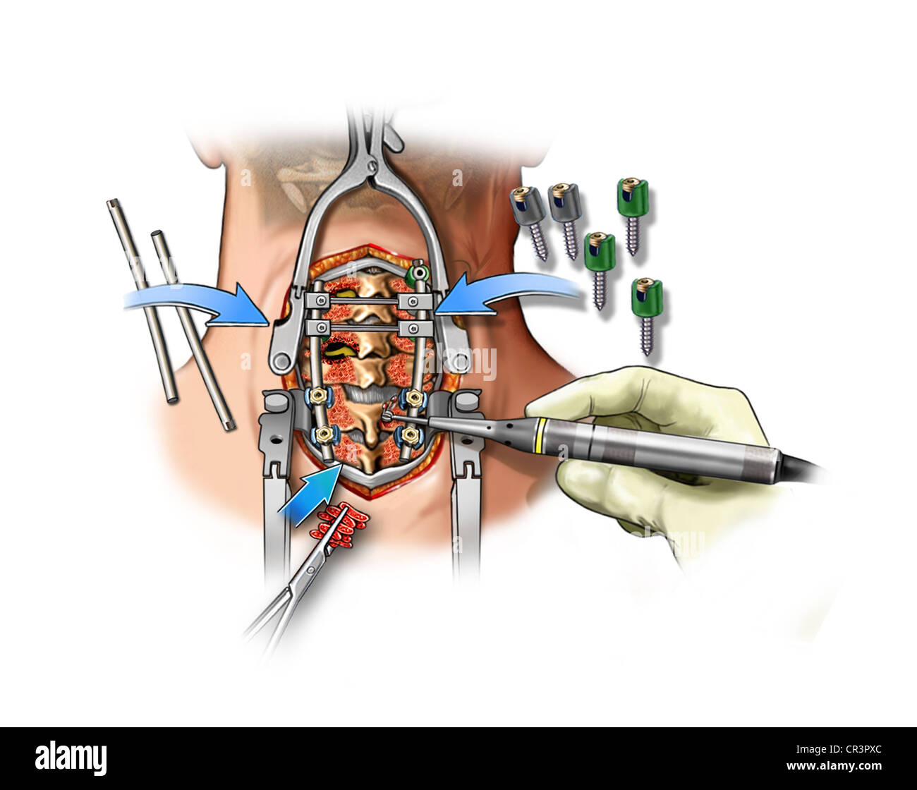 This medical exhibit features a multiple level posterior cervical fusion. Stock Photo