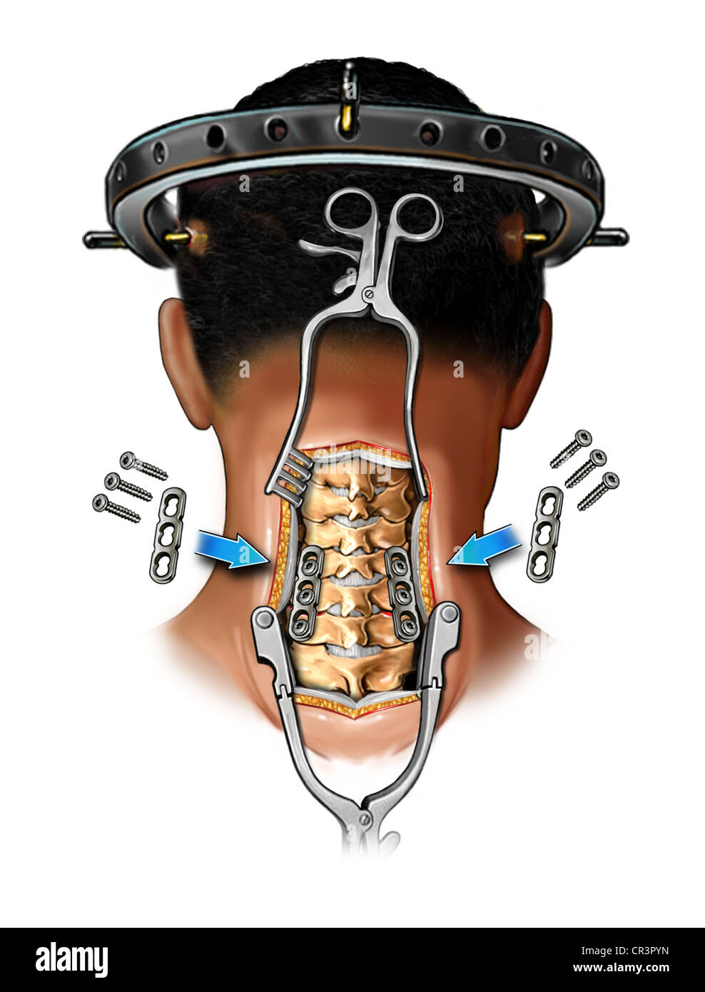 Posterior Cervical Fixation with Plates Stock Photo Alamy