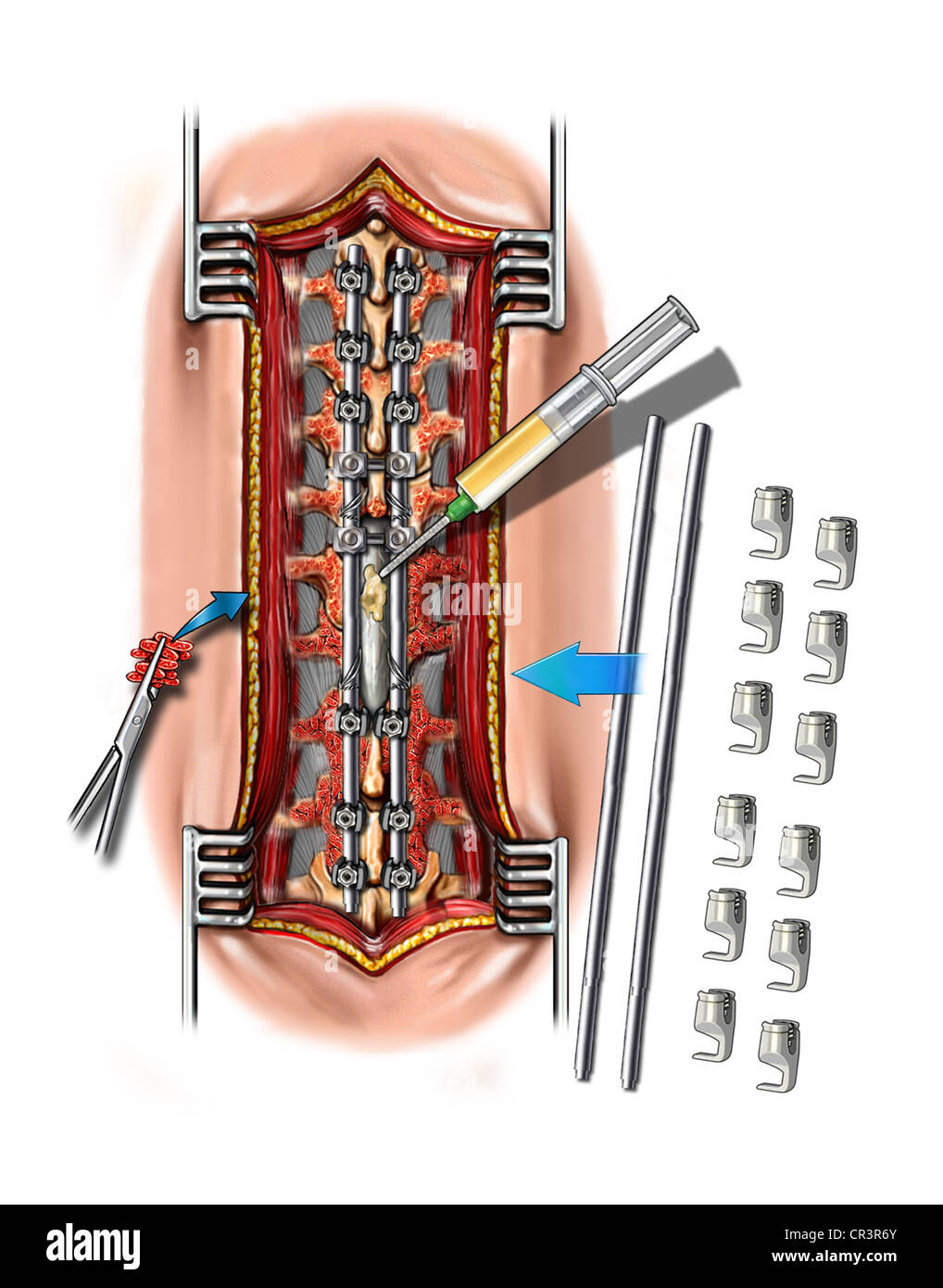 T7-L4 Spine Exposure - Thecal Sac Tear Repair Stock Photo