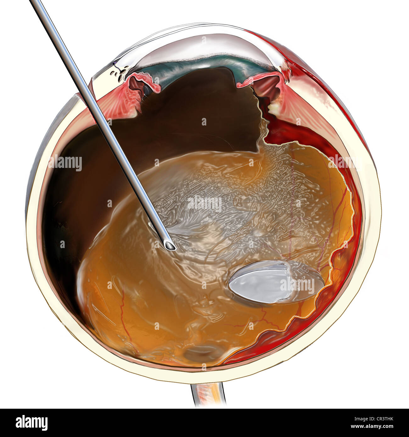 This medical illustration features an cross sectional view of the eye showing the removal of the vitreous humor from the eye. Stock Photo