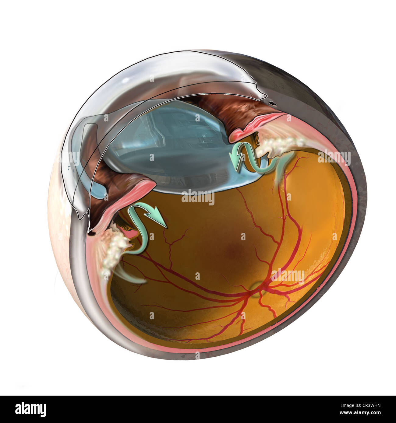 This medical exhibit features a cross section of the eye with a displaced intra-ocular lens. Stock Photo