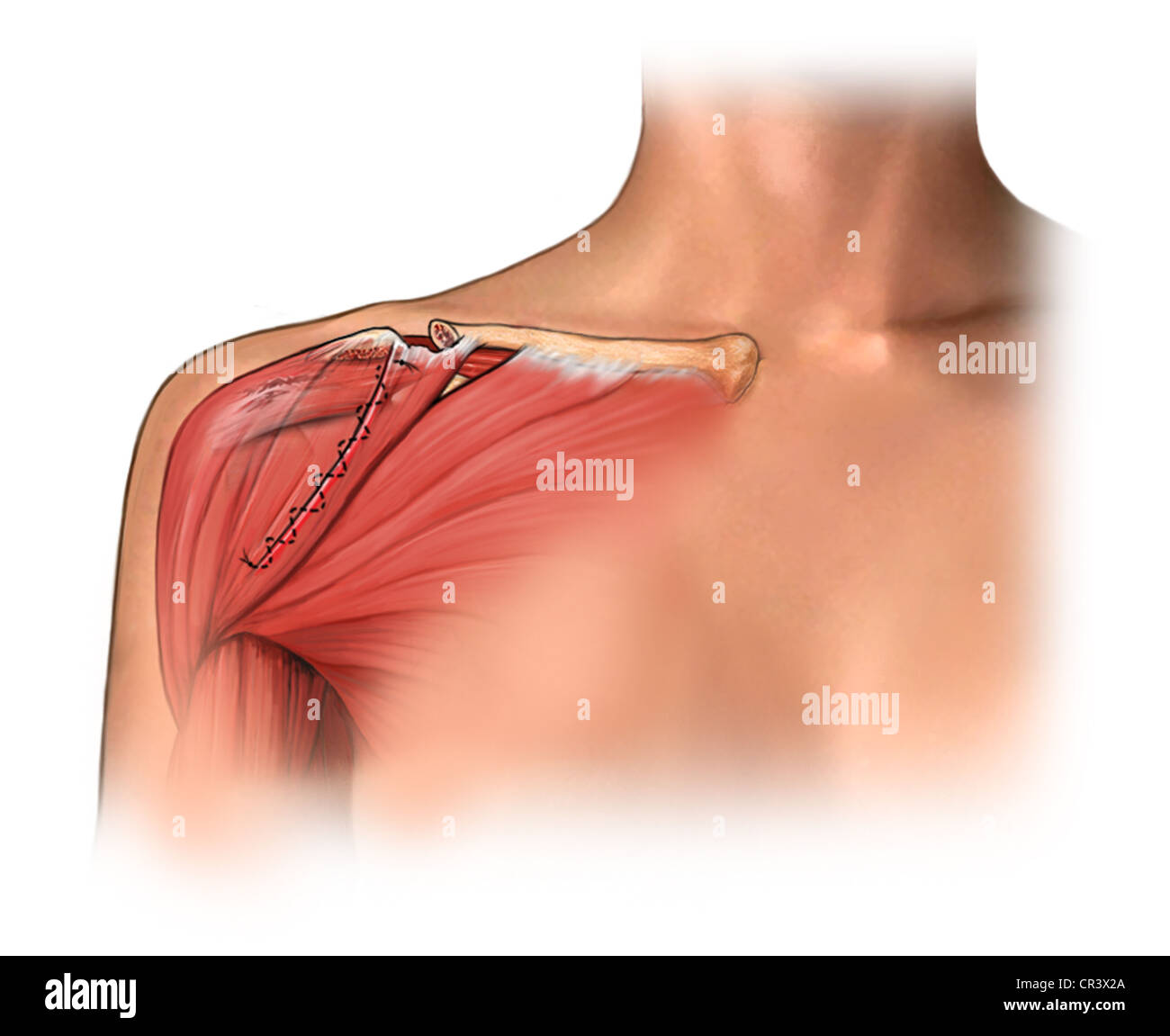 Open Shoulder Surgery Postop Condition Stock Photo Alamy