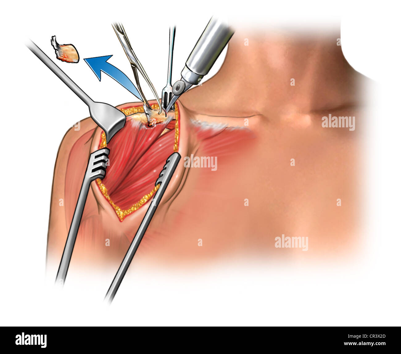 Shoulder surgery hires stock photography and images Alamy