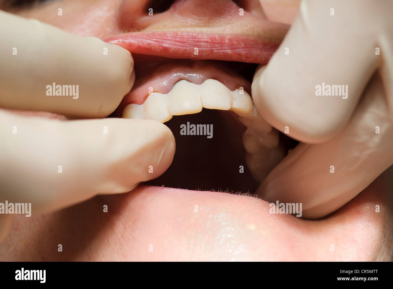 Adjusting the provisional crowns during dental treatment Stock Photo