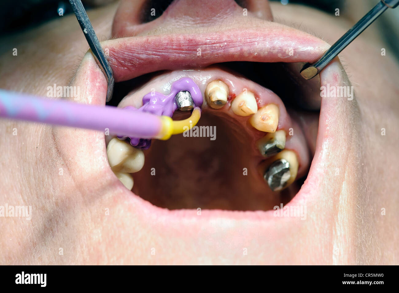 Orthodontist using dental putty to make teeth impressions of a patient  Stock Photo - Alamy