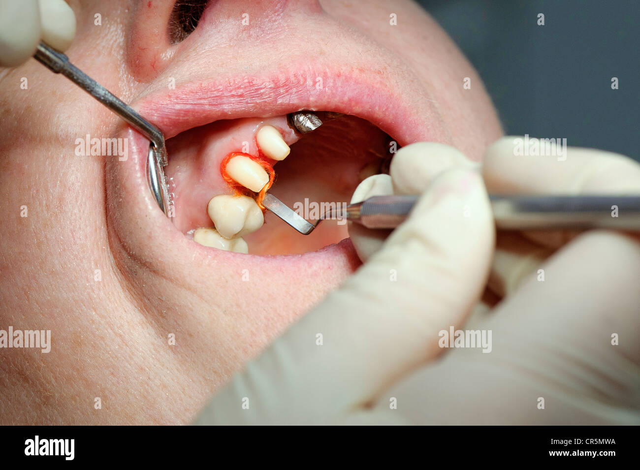 Retraction cord wrapped around the stump of a tooth during dental