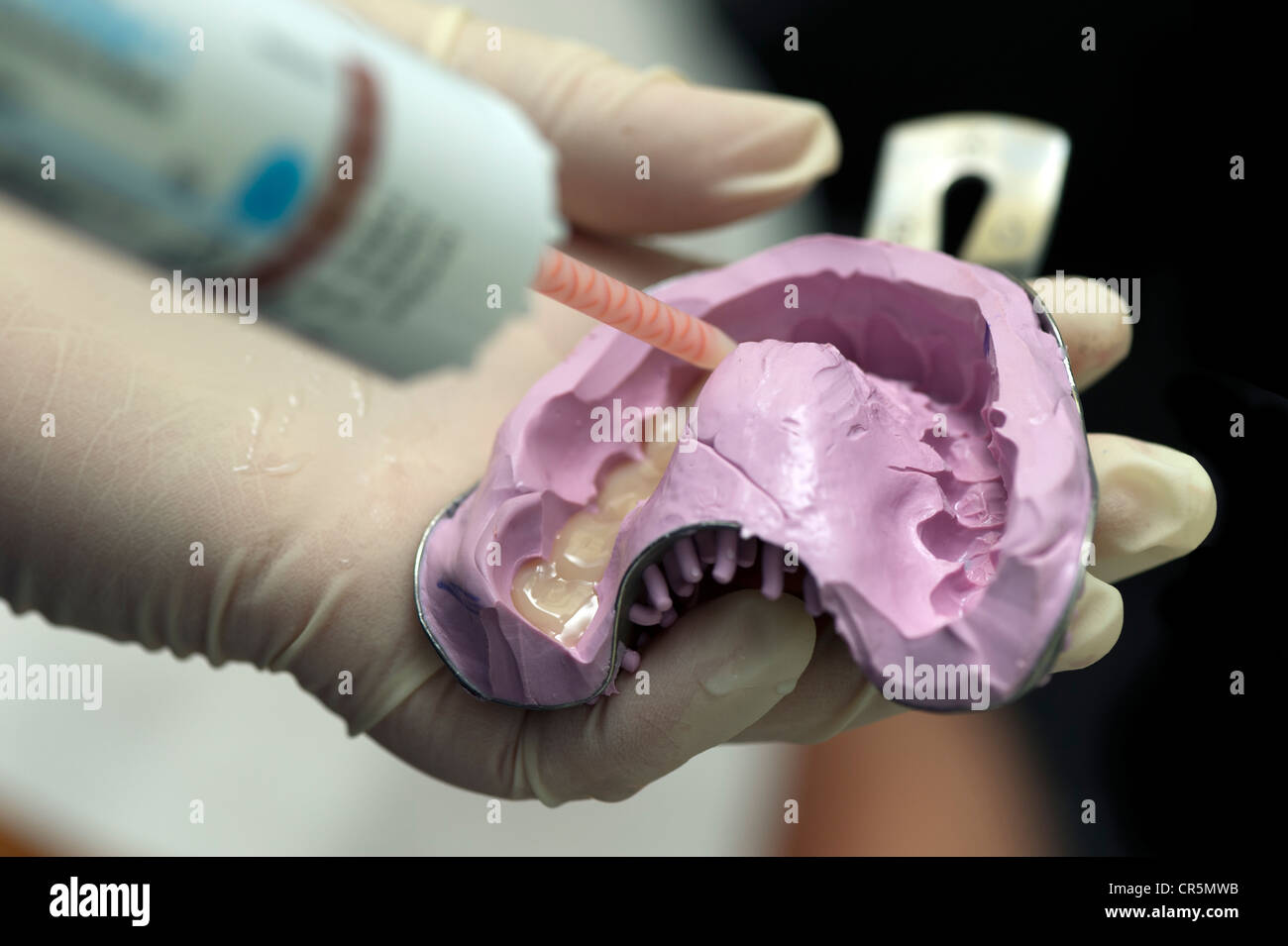 Provisional impression of the maxilla during dental treatment Stock Photo