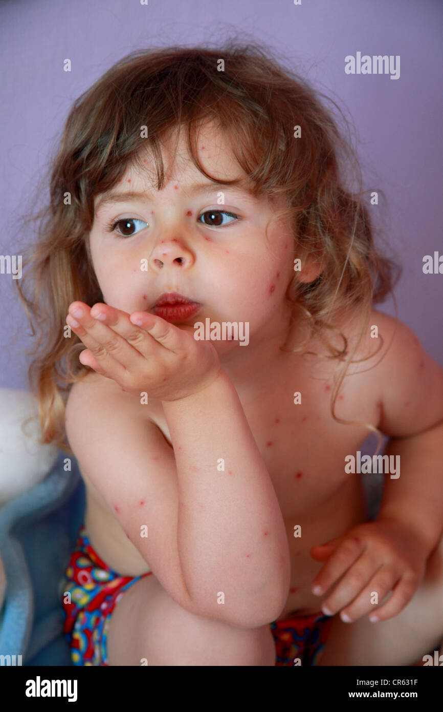 4 years old having chickenpox disease Stock Photo