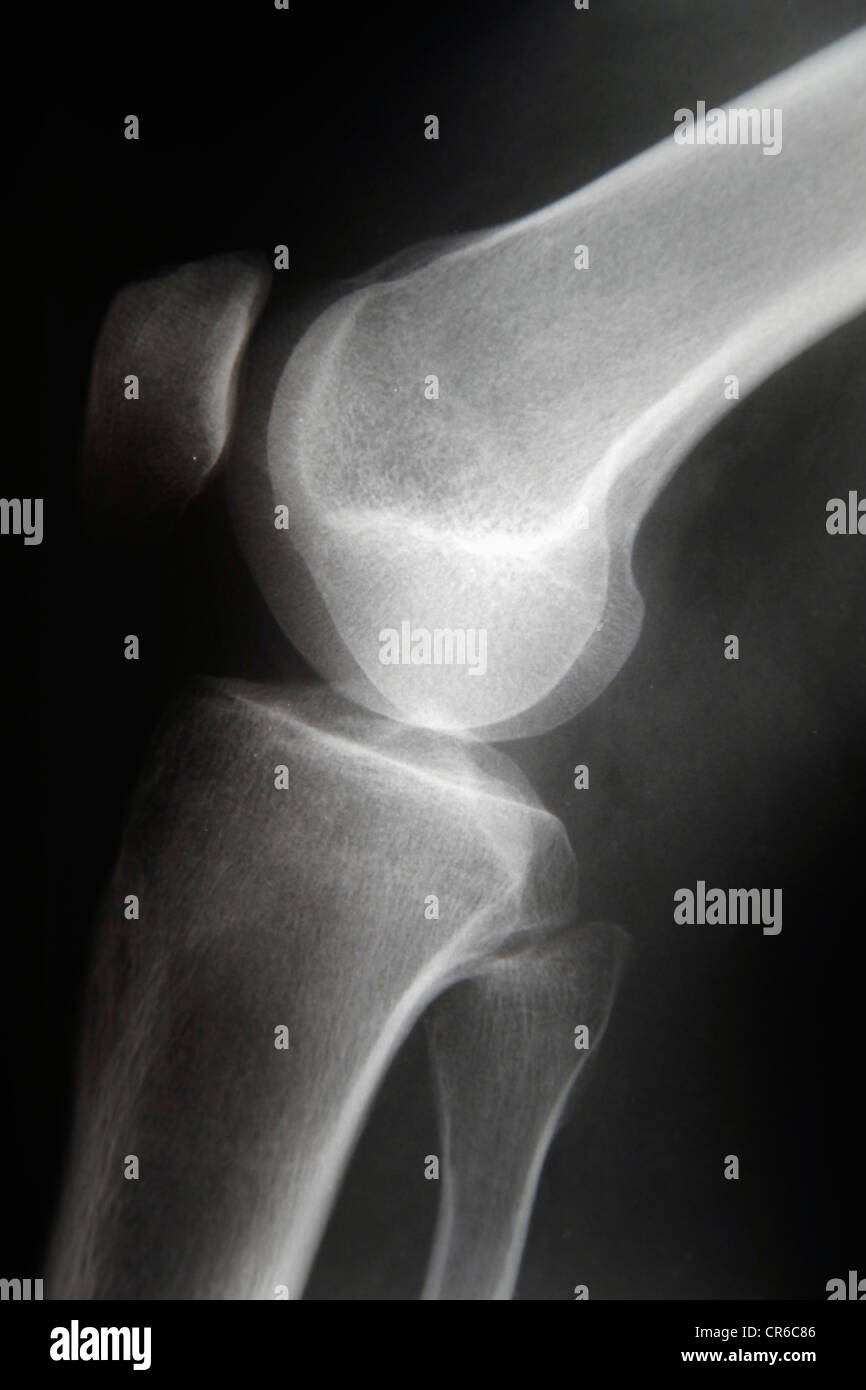 X ray of knee, close up Stock Photo - Alamy