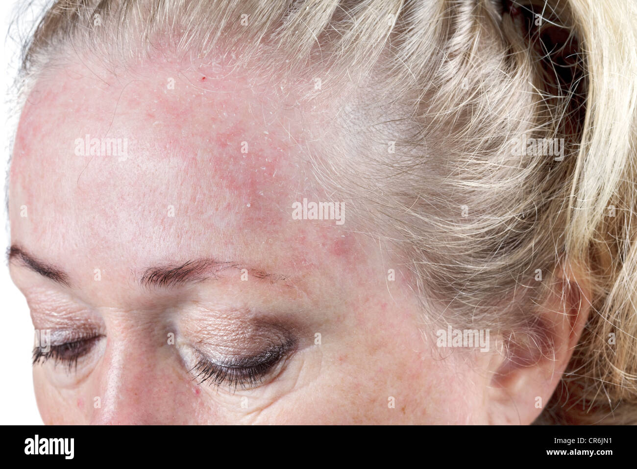 Dry mature dry skin with Dry mature dry skin