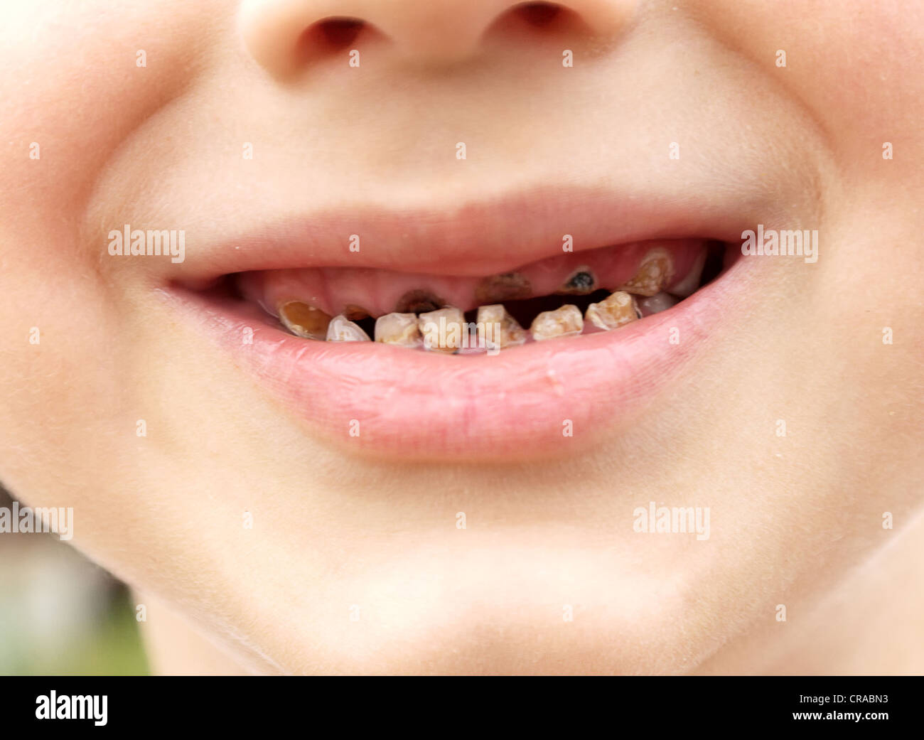 Calf's Teeth decay Toothache because of too many sugar in food Dental Medicine Stock Photo