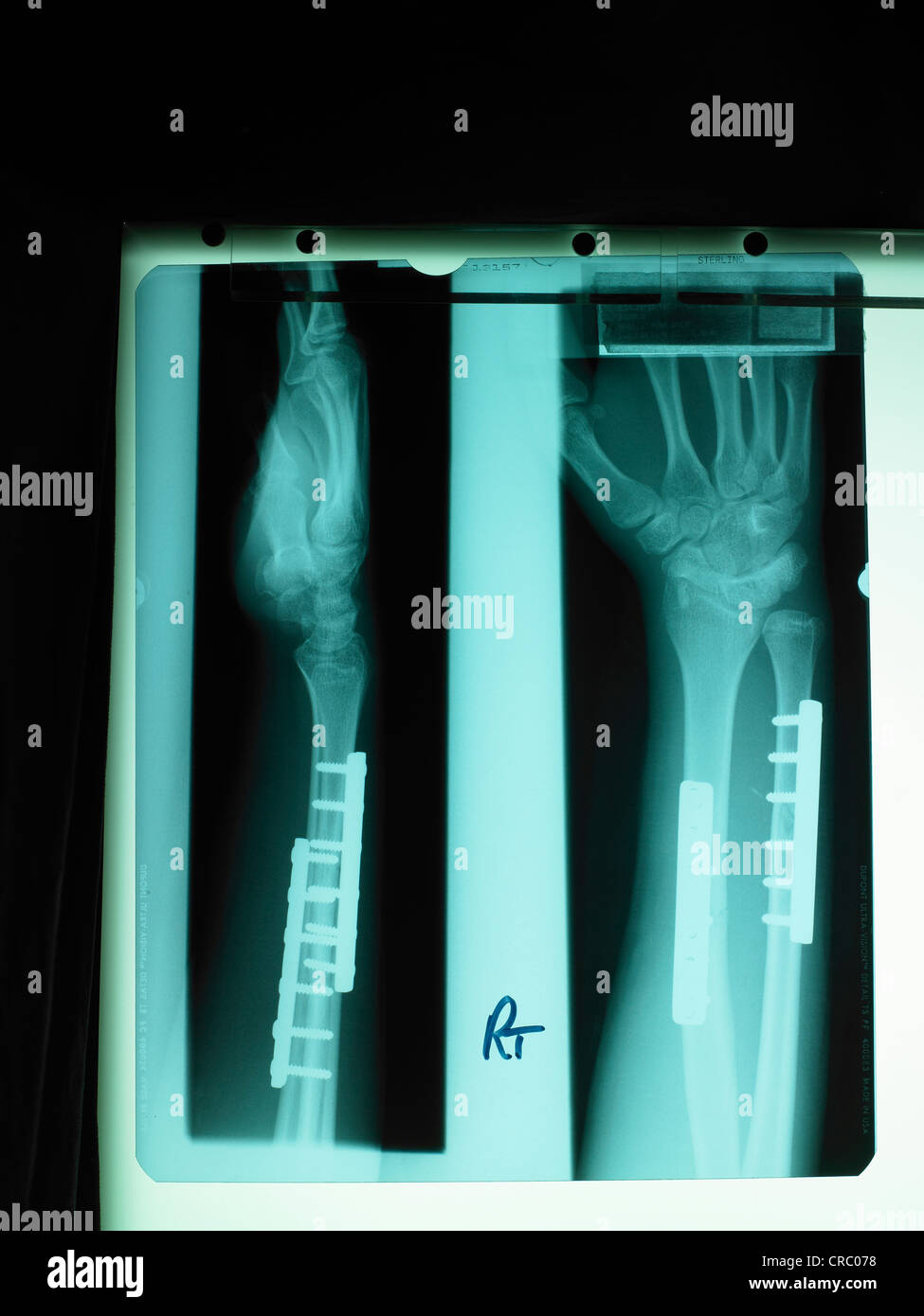 XRay on a Lightbox Stock Photo Alamy