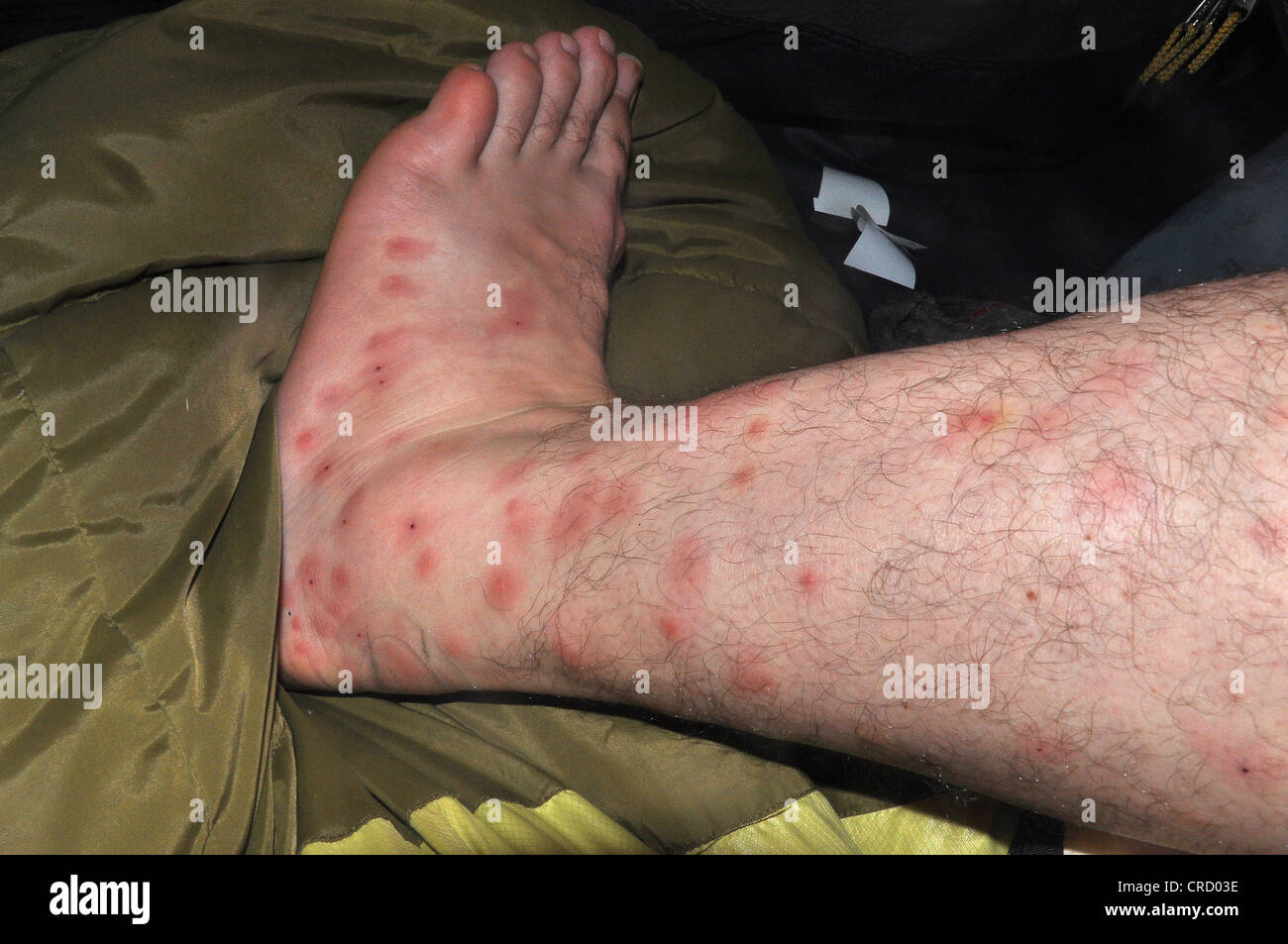 A man's stung leg, mosquito bites, Amazonia, Brazil, South America Stock Photo