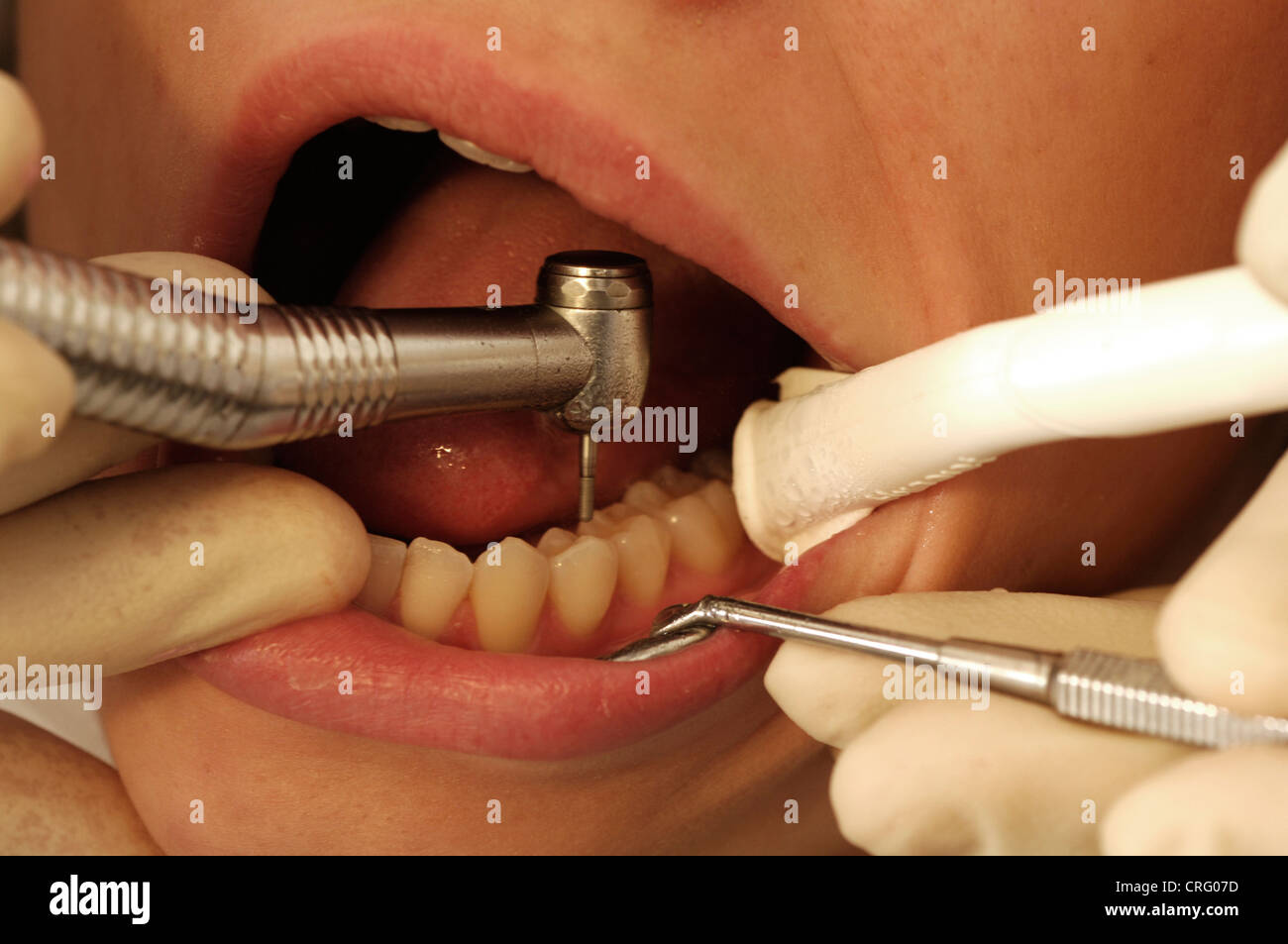 Close-up of a dental drill being used to remove the decayed part of a patient's tooth. Stock Photo