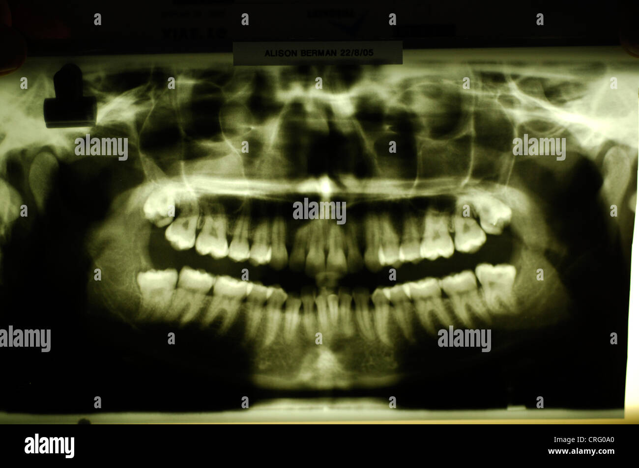 Dental x-ray Stock Photo