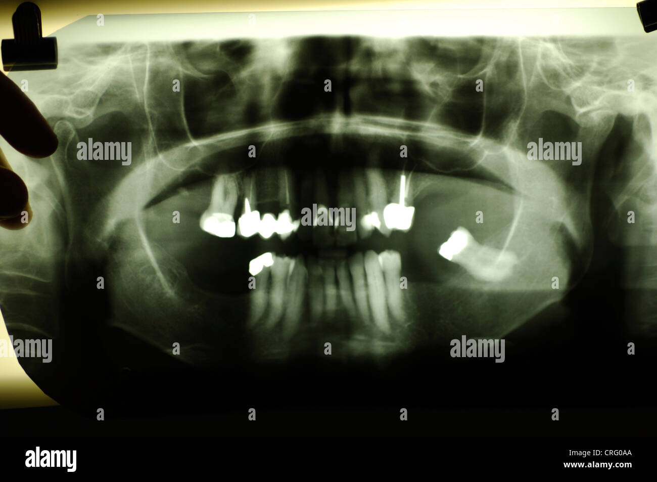 Dental x-ray. Stock Photo