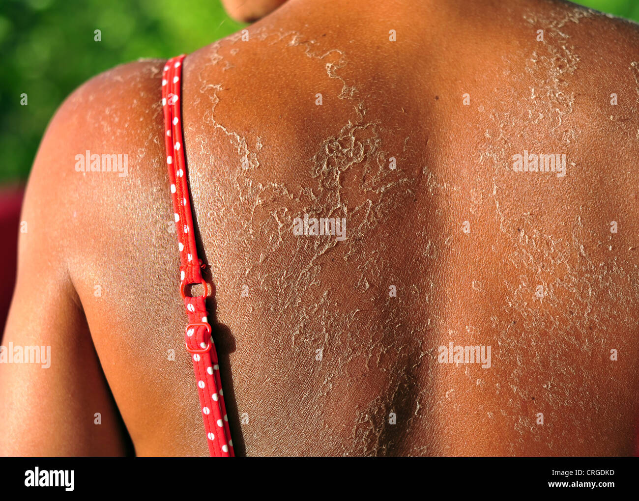 Peeling skin sun hi-res stock photography and images - Alamy