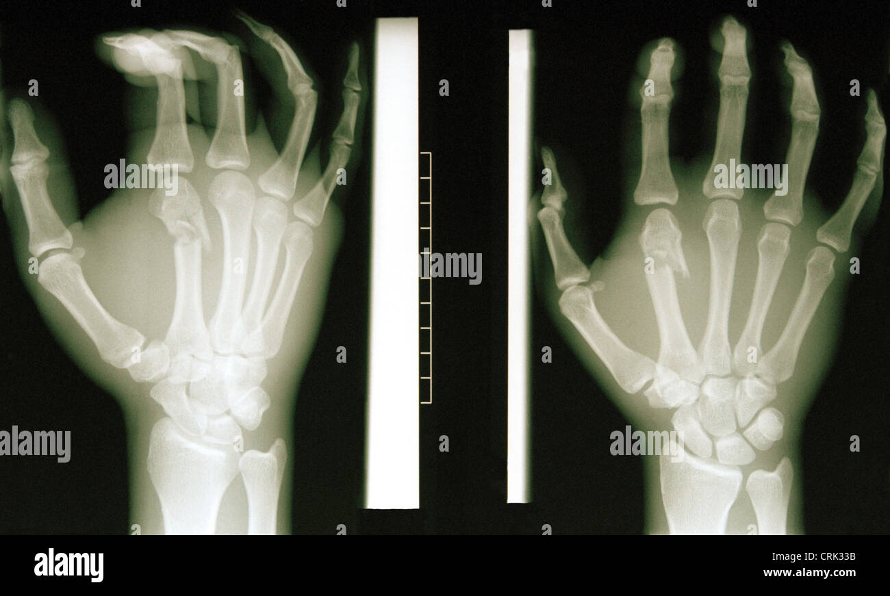 Normal Hand Rentgen Two Roentgenfaufnahmen a right hand Stock Photo - Alamy