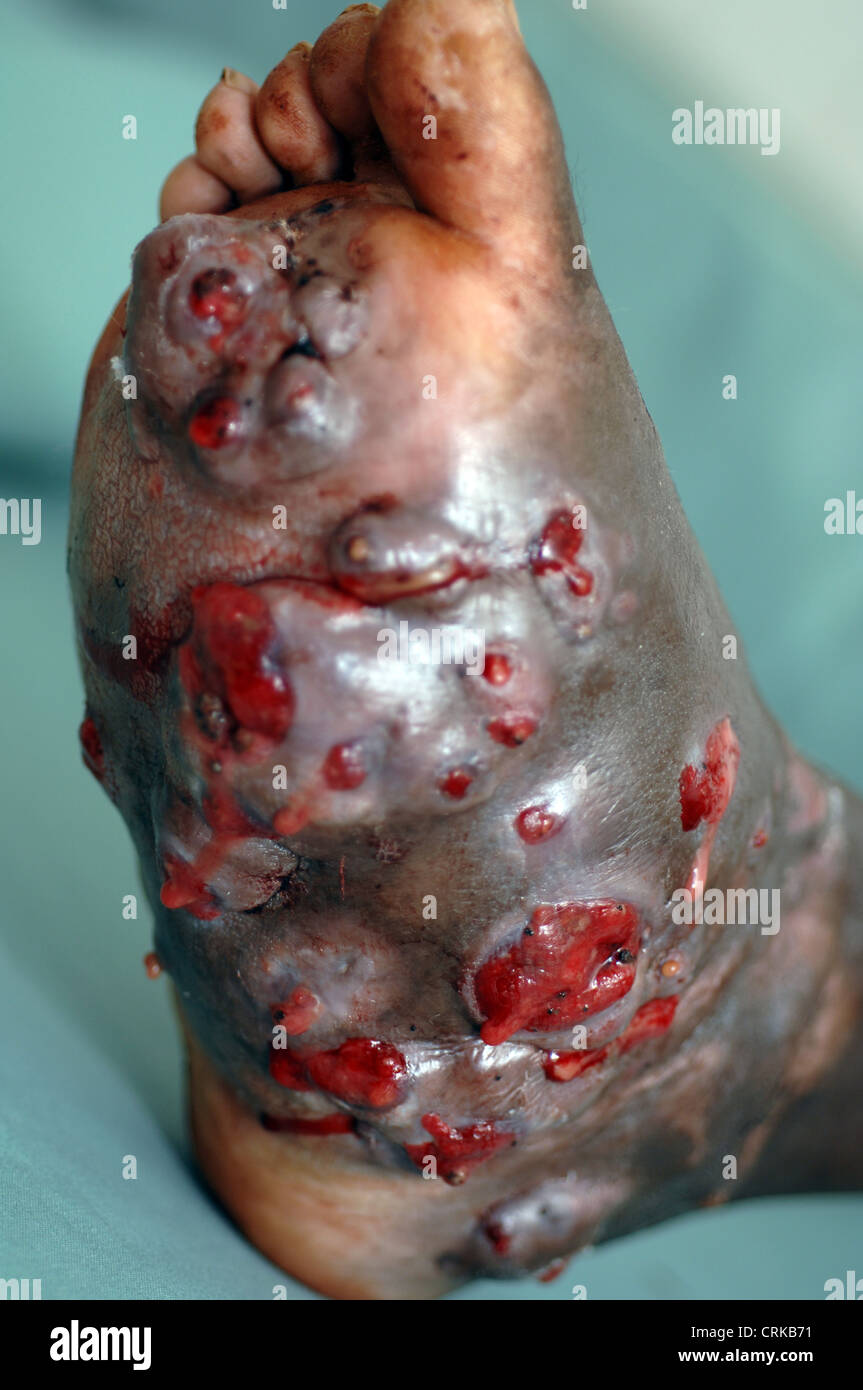 Enlarged foot due to Mycetoma. Mycetoma is an uncommon disease found in the tropics. It is a chronic, localised infection of the skin and underlying tissues characterised by the formation of several abscesses (collections of pus) and granulomas (collections of epitheloid histiocyte cells produced in an immunologic response to the pathogen). Thes Stock Photo