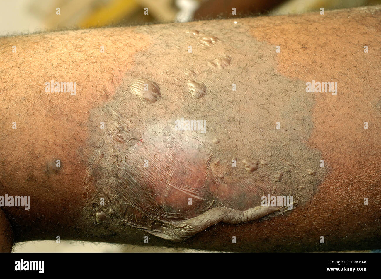 Close up of a the raised sin of a patient suffering from ischaemia. Ischaemia is the restricted blood supply to an area of the body, caused by the narrowing of blood vessels. The skin tissue is beginning to die and will soon become damaged and infected if not treated. Stock Photo
