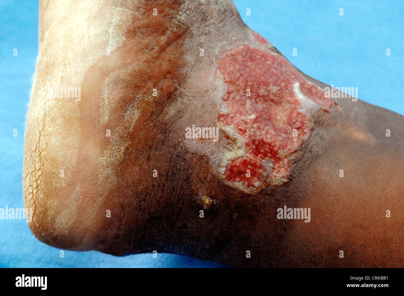 Venous ulcer on the ankle of an elderly man. An ulcer is the open sore on the skin which has failed to heal. The venous ulcer was caused by the restricted oxygen supply to the skin on the leg, caused by DVT (Deep vein thrombosis). Stock Photo