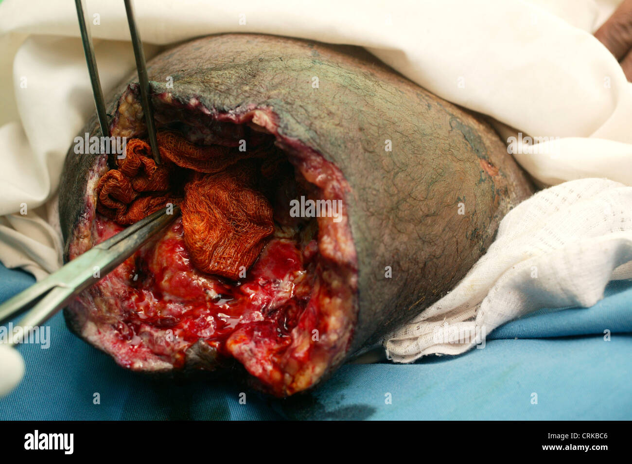 A 52 year old male has the wound of his amputated right lower limb redressed. He lost his leg due to previous ischemia. The open wound is cleaned before being dressed to prevent further infection. Stock Photo