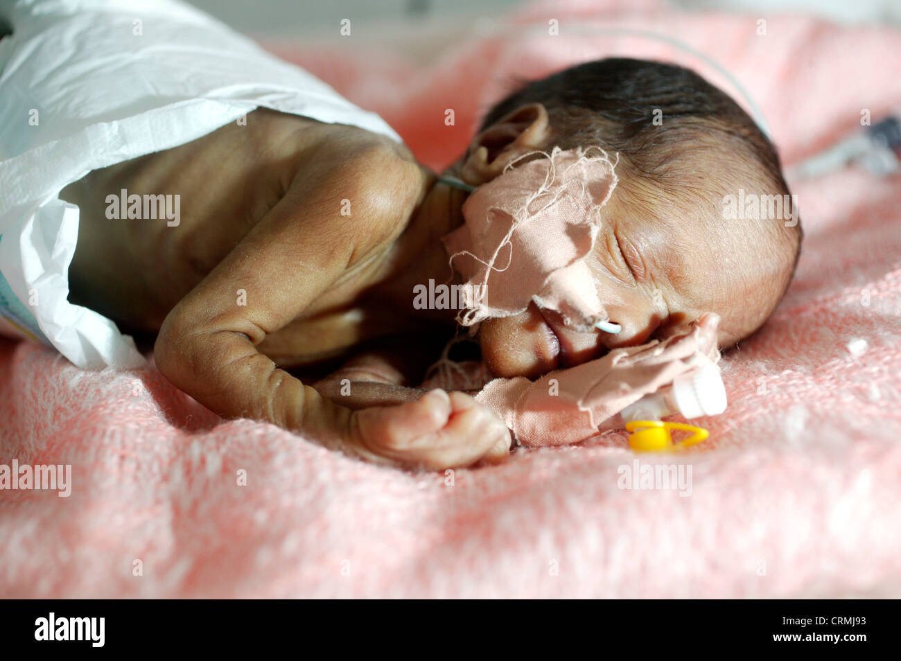A 5 day old baby born premature at 31 weeks weighing 1kg. The baby is suffering with respiratory distress syndrome and jaundice. Stock Photo